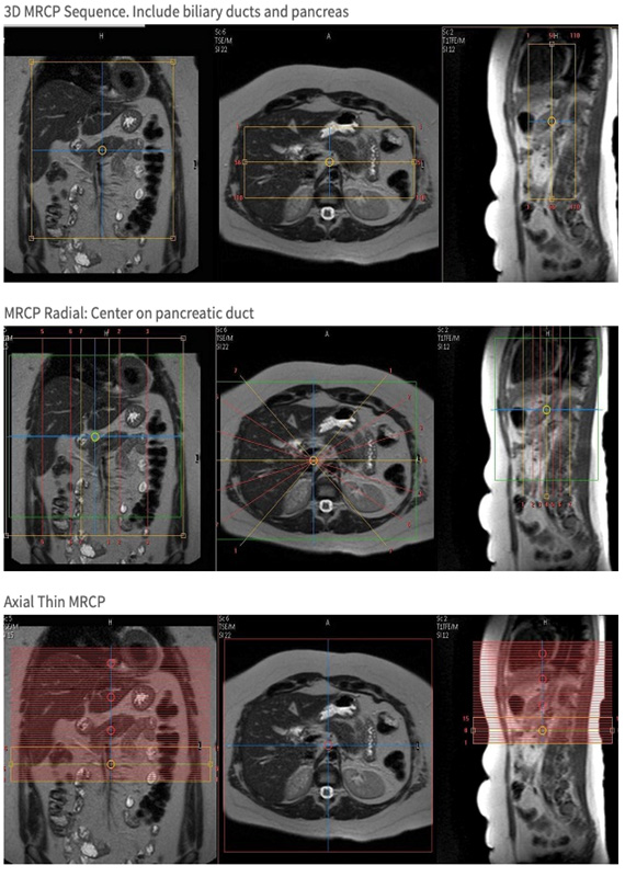 MR Liver Mass with MRCP WO BODY Protocol OHSU